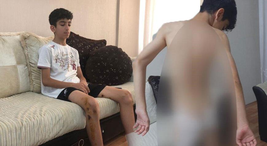 Ankara’da sokak köpeği dehşeti! 13 yaşındaki çocuk mevtten döndü